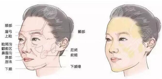 深圳维多利亚门诊部面部填充案例
