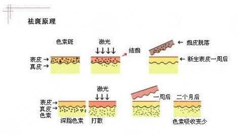 北京鸿滨极光医疗美容激光祛斑案例