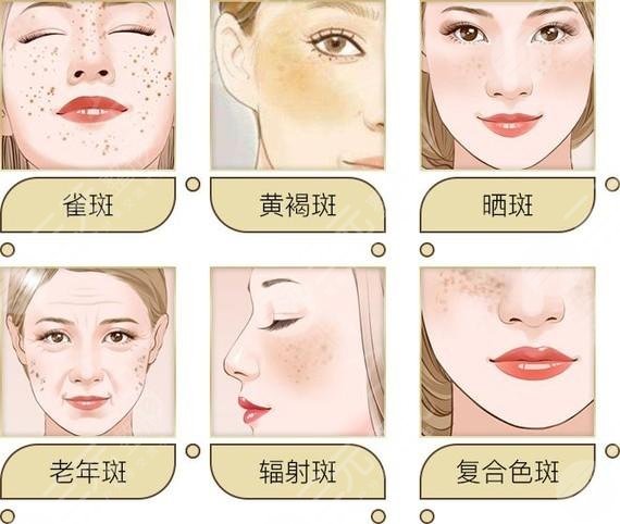 番禺中心医院皮肤科激光祛斑案例分享