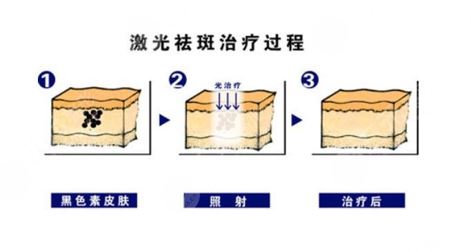番禺中心医院皮肤科激光祛斑案例分享