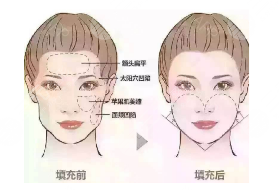 荆州沙市华美整形医院面部脂肪填充案例分享：术后1个月