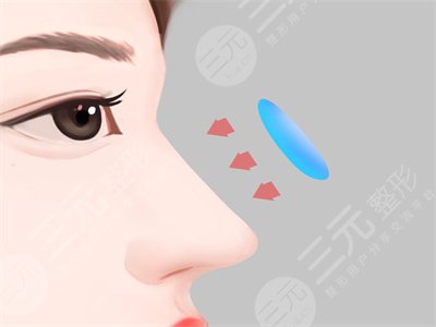上海伊莱美肋骨鼻整形后22周