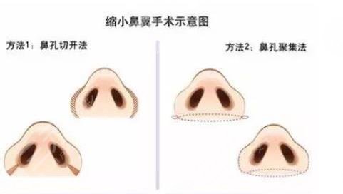 鼻翼缩小