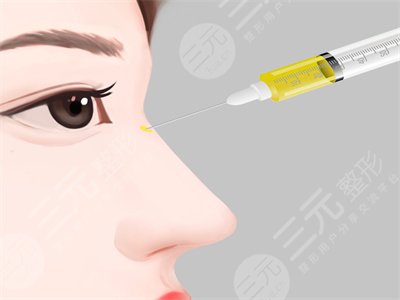上海m国际整形医院隆鼻案例