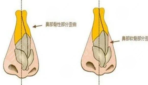 歪鼻矫正