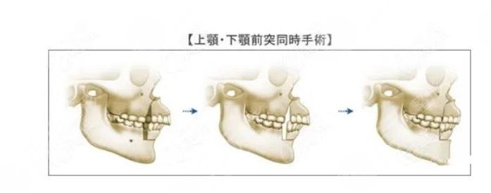 正颌手术案例