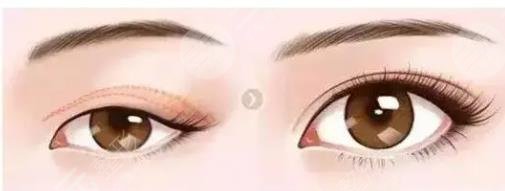 双眼皮