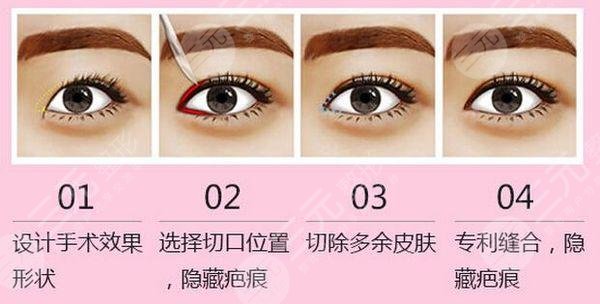 开内眼角是所有人可以做吗?