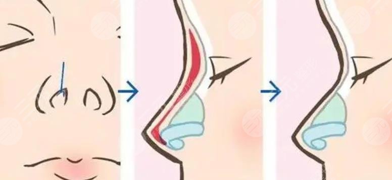 隆鼻整形手术是怎样操作的?