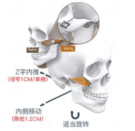 上海九院颧骨整形案例