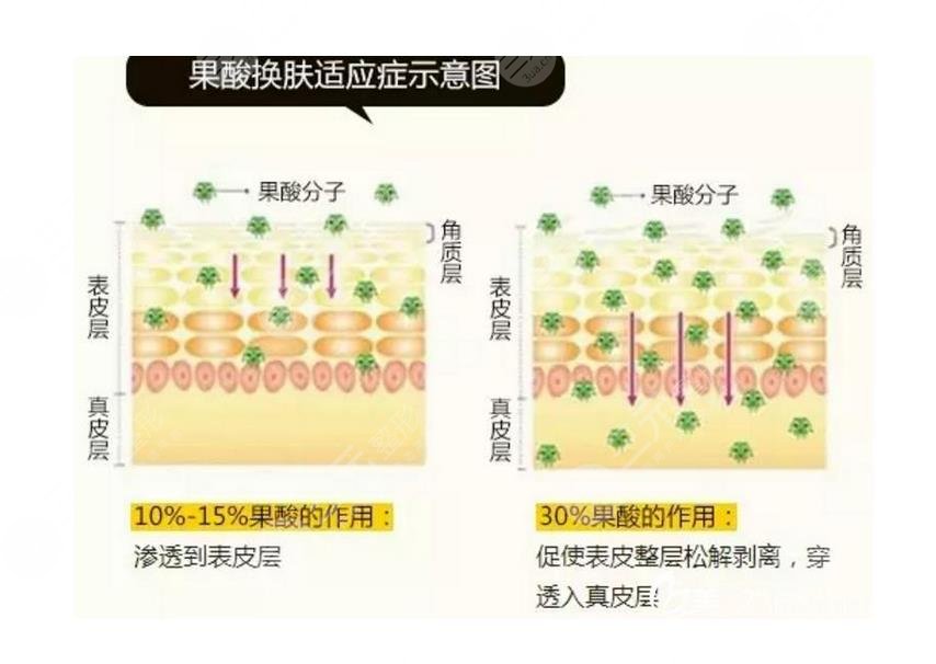 深圳阳光做果酸换肤怎么样?