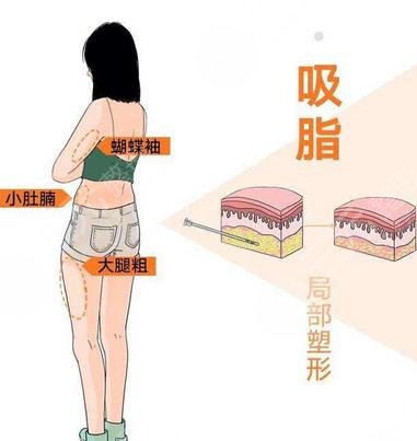 成都军大整形医院大腿吸脂案例
