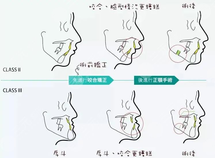 正颌手术