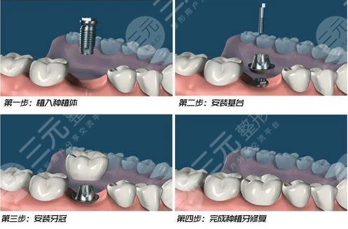 宁波种牙医院排名前三、前五、前十来袭~医院口碑测评&附种牙价格表!