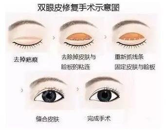 大连双眼皮修复好的医院排名公布！5家口碑医院盘点，值得选择~