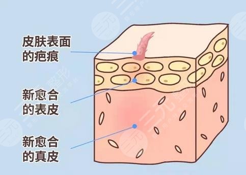 疤痕的形成