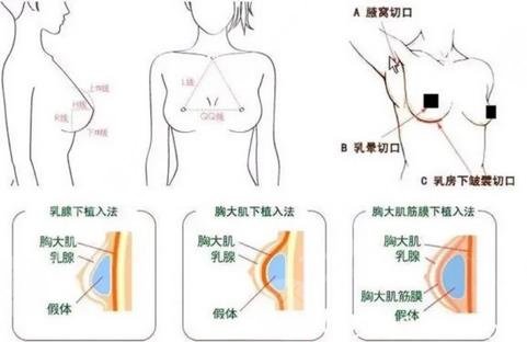 假体隆胸原理