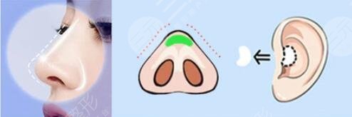 长春铭医隆鼻案例