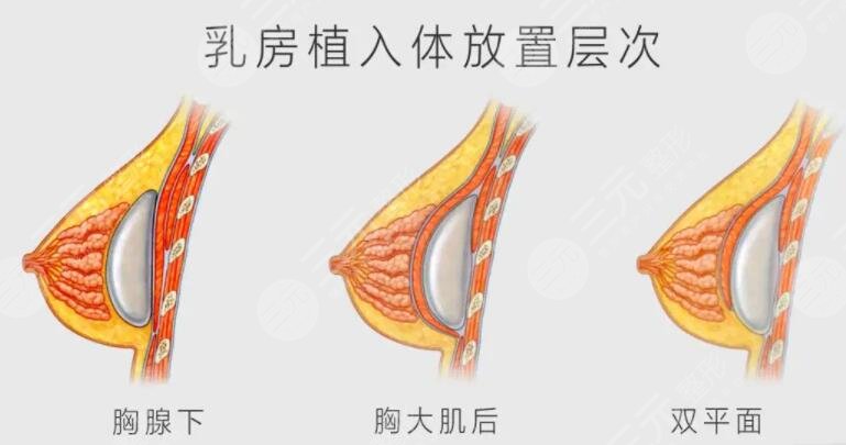 自体脂肪隆胸案例