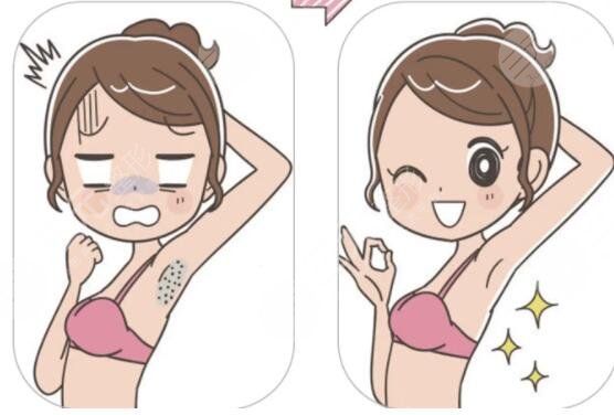 广医三院激光脱毛案例