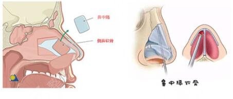 中山一院整形美容科隆鼻案例
