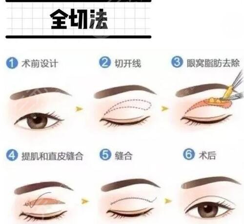 佳木斯二院割双眼皮案例