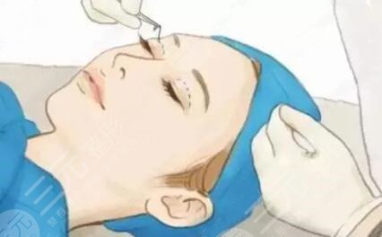 米兰柏羽医学美容医院隆鼻双眼皮术后