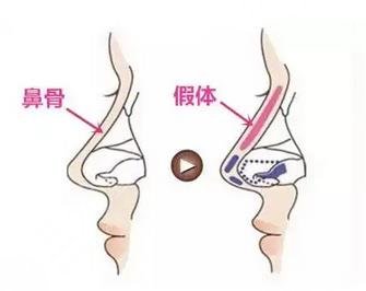 深圳隆鼻医院前十名排名曝光!口碑实力具兼|附隆鼻价格表~ 深圳隆鼻医院前十名排名曝光!口碑实力具兼|附隆鼻价格表~