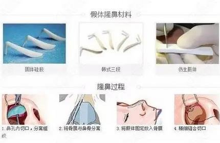深圳三甲医院隆鼻哪家好?榜单排名前5公布!看看有没有你心仪的~ 深圳三甲医院隆鼻哪家好?榜单排名前5公布!看看有没有你心仪的~