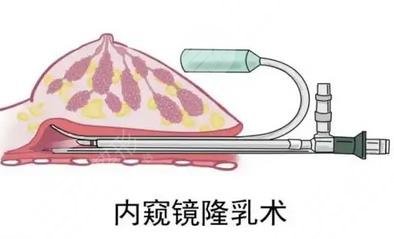 上海隆胸好的整形医院排名前五公布!爱度、臻禾等实力口碑具兼,值得选择 上海隆胸好的整形医院排名前五公布!爱度、臻禾等实力口碑具兼,值得选择