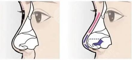 上海隆鼻好的医院有哪些?口碑严选排行前5公开~实力强,设备全! 上海隆鼻好的医院有哪些?口碑严选排行前5公开~实力强,设备全!