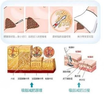 北京专业吸脂的医院有哪些？榜单排名前5揭秘|丽都、欧亚美等凭实力上榜~