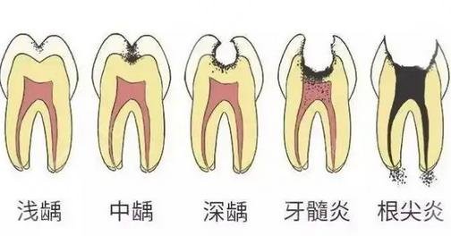 牙髓炎