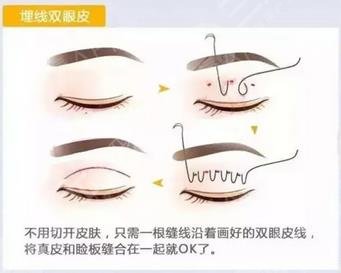 珠海人民医院割双眼皮价格如何?医生介绍&双眼皮案例&全新价格表一览 珠海人民医院割双眼皮价格如何?医生介绍&双眼皮案例&全新价格表一览