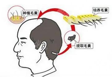 徐州三院植发科好不好?公立三甲医院实力不容小觑~附植发价格表哦! 徐州三院植发科好不好?公立三甲医院实力不容小觑~附植发价格表哦!