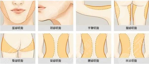 吸脂减肥